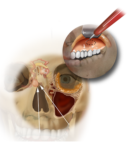 Combined endoscopic endonasal and transmaxillary surgery to remove a deep-seated chondrosarcoma near the internal carotid artery.